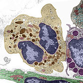 Eosinophil and Mast Cell (transmission electron microscopy